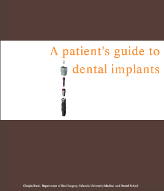 A patient's guide to dental implants